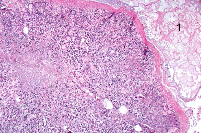 A higher-power photomicrograph of the previous slide contains a small area of fat necrosis (1) in the upper right portion of the image. The fat necrosis is within the fat tissue that is normally found adjacent to the pancreas. The appearance of the pancreatic tissue in this area is somewhat disrupted due to autolysis (the pancreas autolyzes very rapidly after death) but there is some premortem necrosis as well.