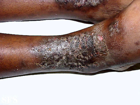 Eczema microbic. Adapted from Dermatology Atlas.[2]