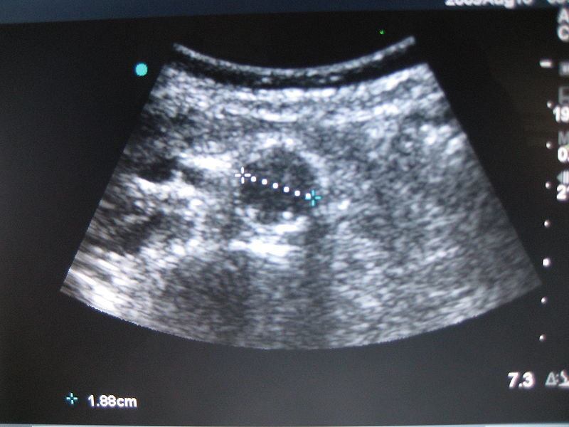 File:US normal abdominal aorta.JPG
