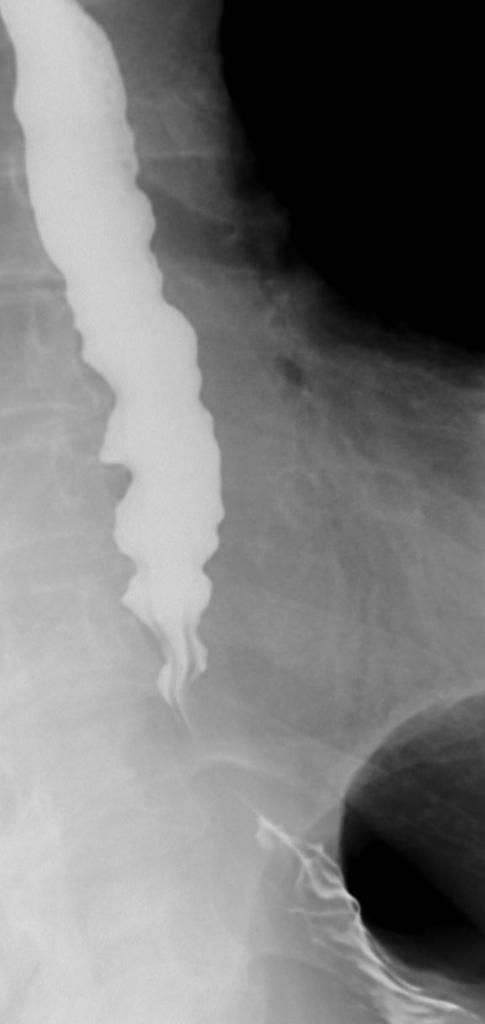 File:Achalasia-and-tertiary-waves.jpg