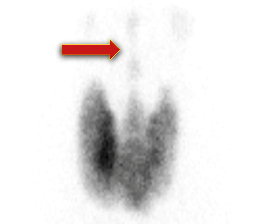 Thyroid scan of a Grave's disease patient showing increaed iodine uptake and visualization of the pyramidal lobe (which is not normally seen) - Case courtesy of Dr Arshdeep Sidhu, <a href="https://radiopaedia.org/">Radiopaedia.org</a>. From the case <a href="https://radiopaedia.org/cases/21945">rID: 21945</a>
