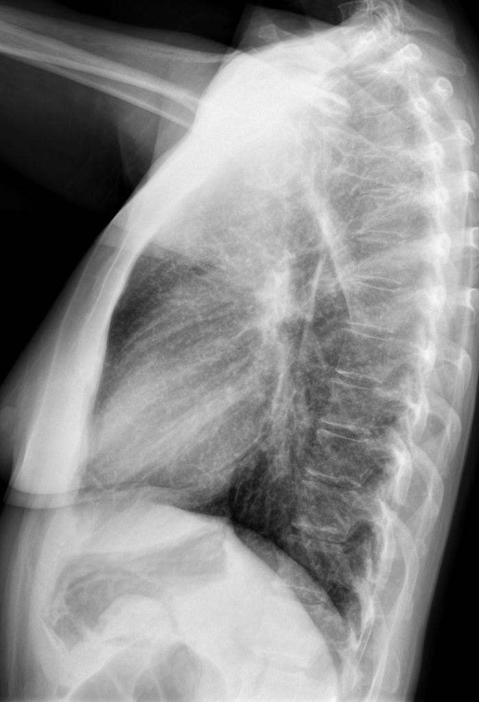 Miliary lung nodules consistent with prior and healed varicella pneumonia. [6]