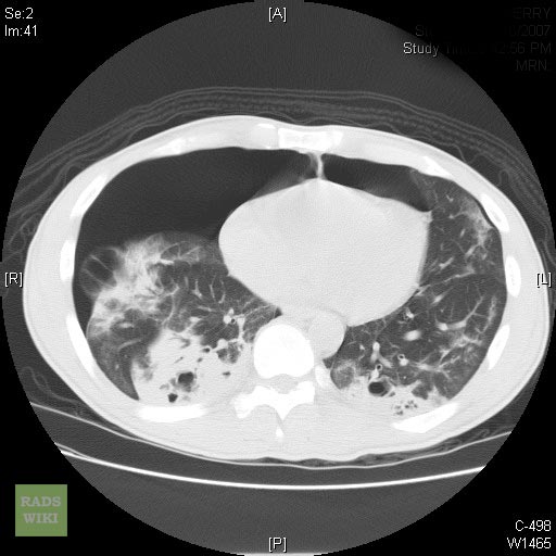 Patient with known PCP presents with acute shortness of breath