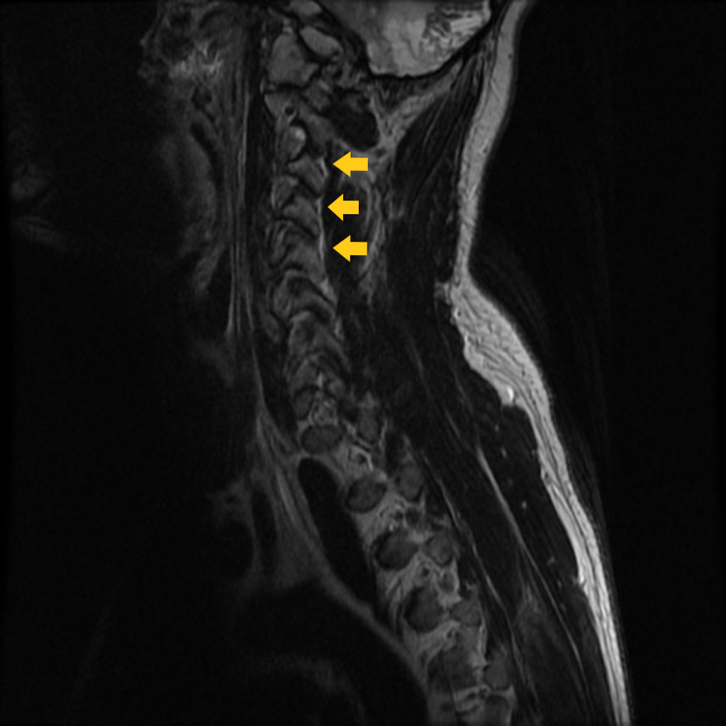 File:Spinal nerve root enhancement MRI.png