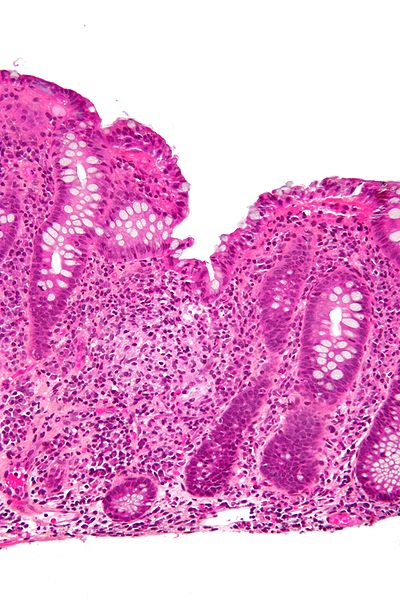 File:400px-Colitis with granuloma high mag.jpg