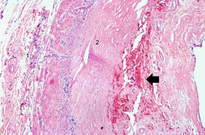 This is a higher-power photomicrograph of the vessel wall. The adventitia (1) and the media (2) contain inflammatory cells. The recanalized portion of the vessel is composed of fibrous connective tissue and contains numerous small blood vessels. There is a small area of hemorrhage (arrow) in the central portion of this image.