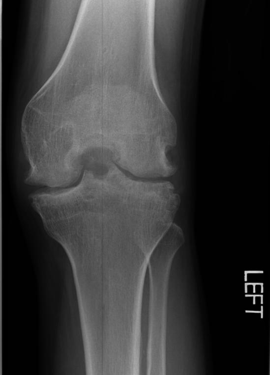 X-ray of the ankle in a patient with Hemophilia
