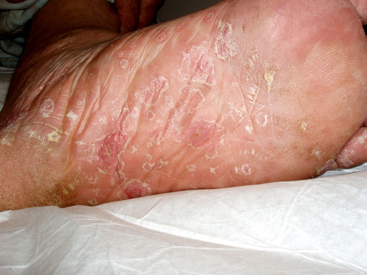 Erruption on Sole of Foot Associated with Secondary Syphilis.