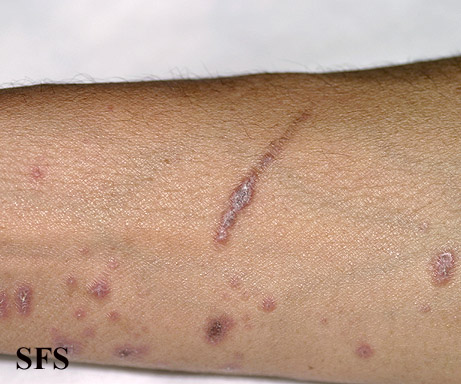 Lichen planus. Adapted from Dermatology Atlas.[1]