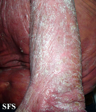 File:Mycosis fungoides 07.jpg