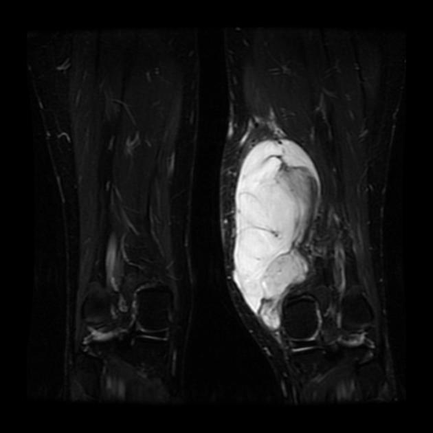 File:Myxoid Liposarcoma of the Thigh.jpg