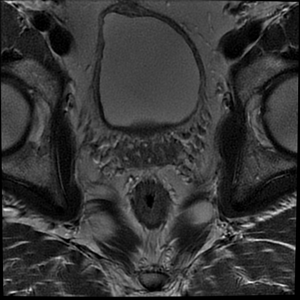File:Granulomatous prostatitis MRI.gif