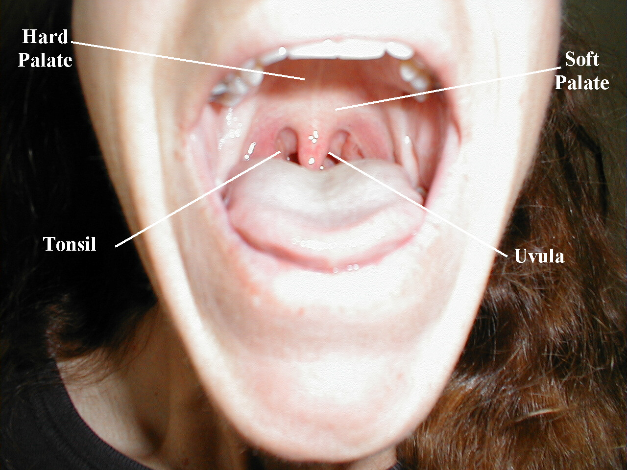 Normal Oropharynx