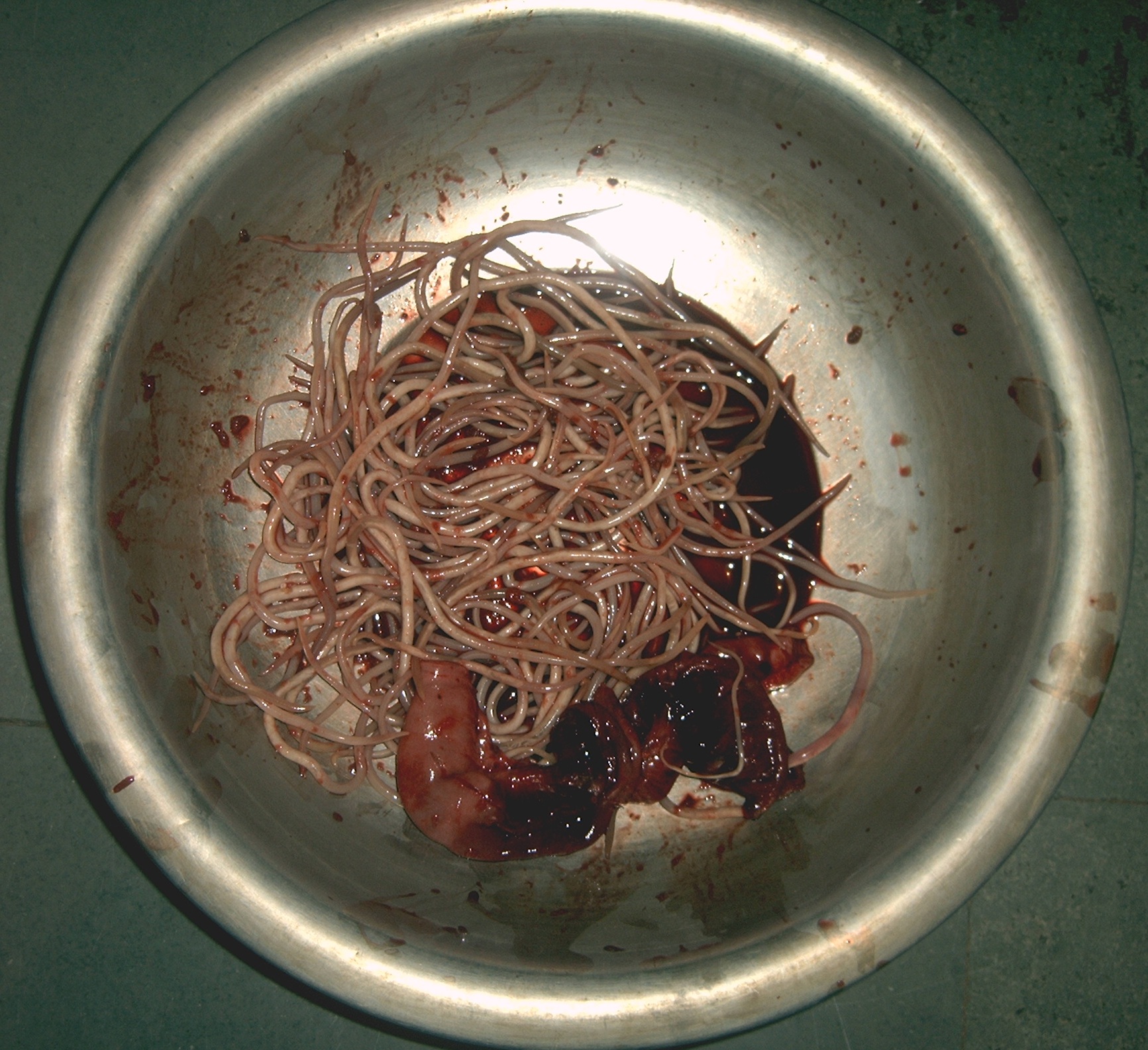 Ascaris lumbricoides caused gangrene of ileum (shown worms removed from a child)