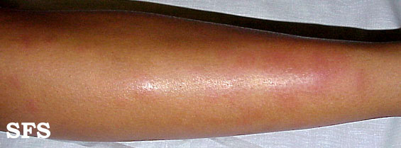 .:Erythema nodosum Adapted from Dermatology Atlas.[12]