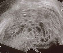 File:Molar pregnancy.jpg