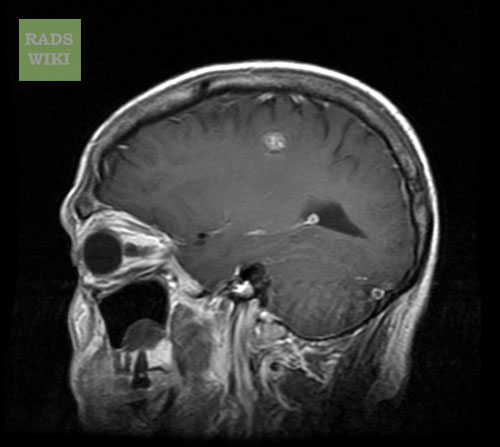 MRI: Cavernous malformation