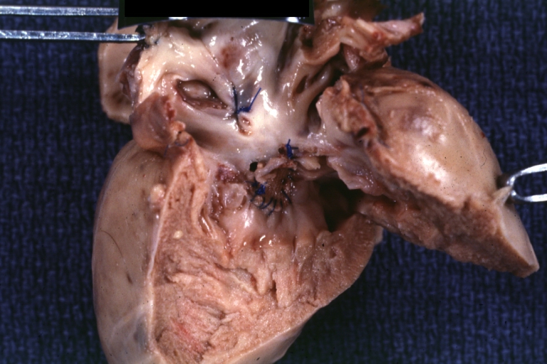 Perimembranous Interventricular Septal Defect: Gross, fixed tissue, view from right atrium and ventricle with patch placed three days prior to death.