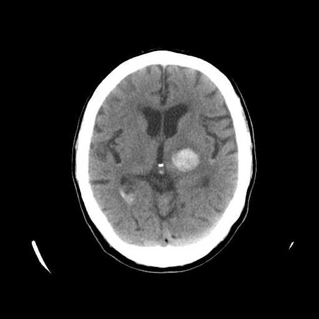Hemorrhagic stroke in the left basal ganglia
