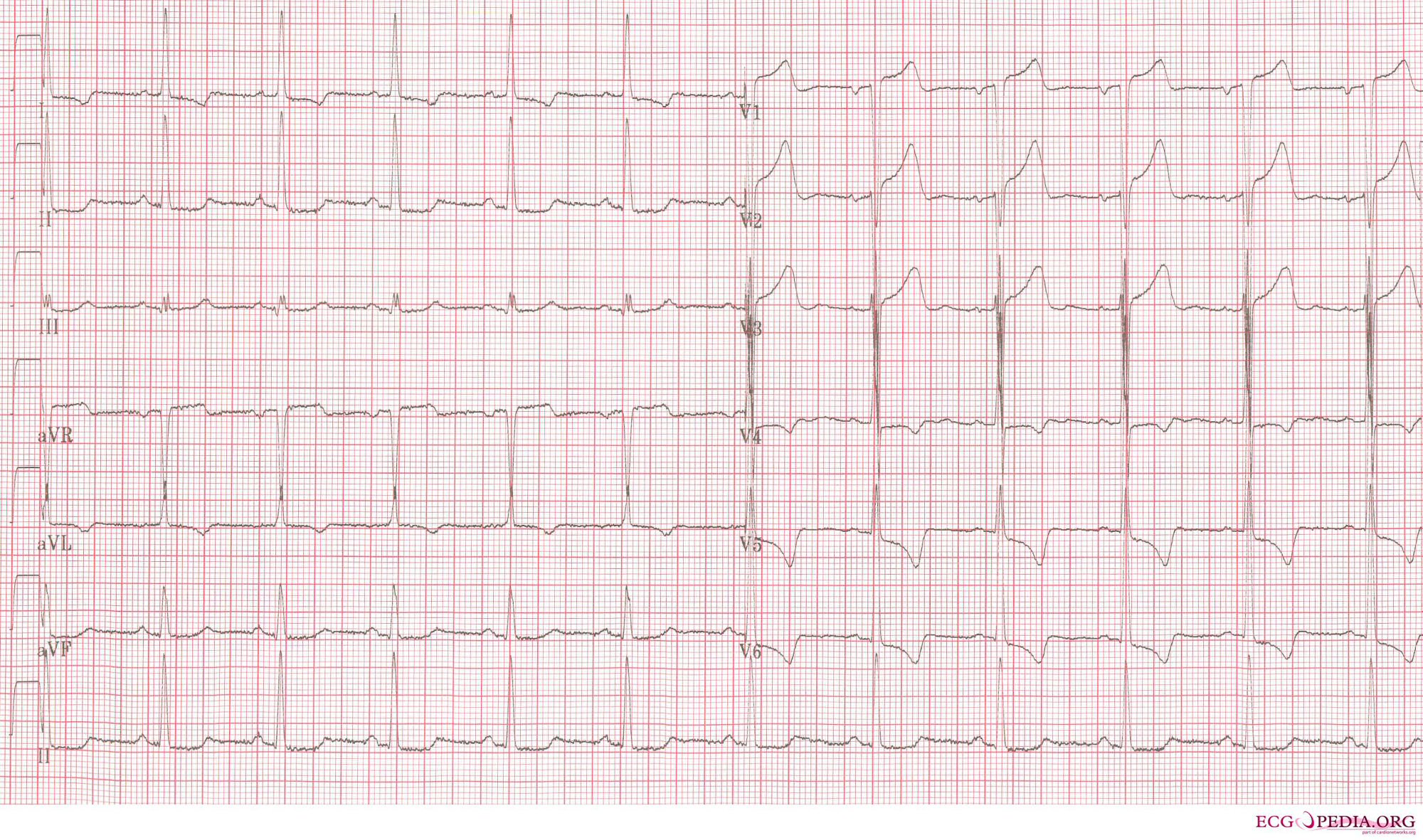ECG of a patient with LVH and subendocardial ischemia leading to positive cardiovascular markers in blood testing.