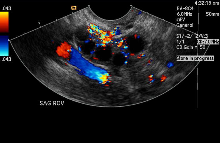 File:Ovarian-hyperstimulation-004.jpg