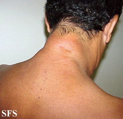 Reticular erythematous mucinosis. Adapted from Dermatology Atlas.[3]