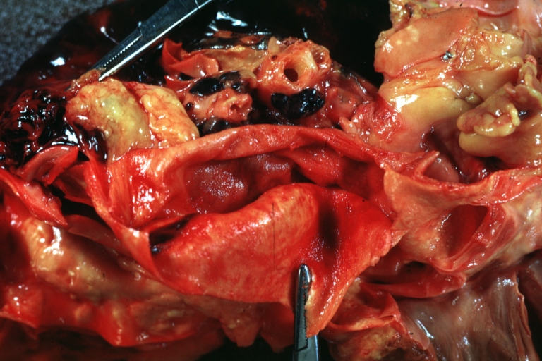 Dissecting Aneurysm: Gross, Type I shows false channel