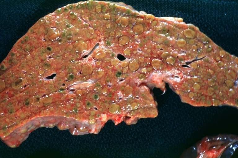 Macronodular cirrhosis: Gross, natural color slab of liver