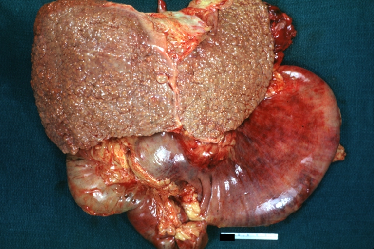 Gross, natural color of liver and stomach view from external surfaces, micronodular cirrhosis and hemorrhagic gastritis (as the surgeon would see these in natural color)