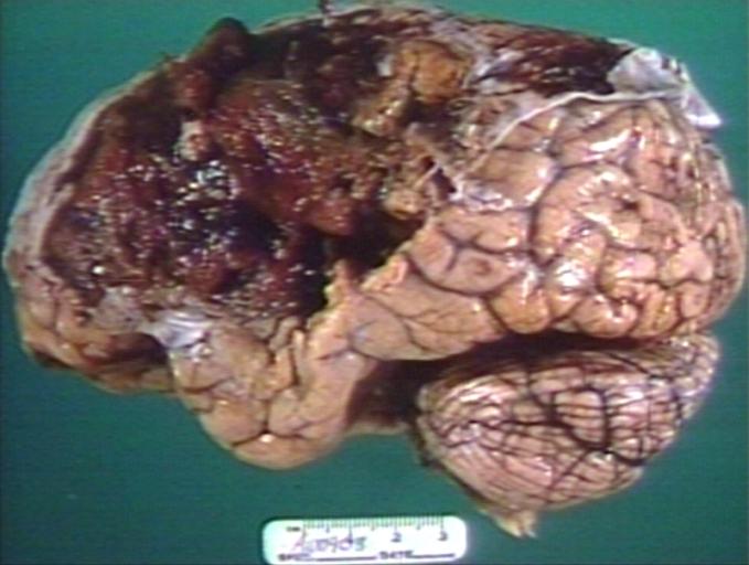 Brain: Oligodendroglioma