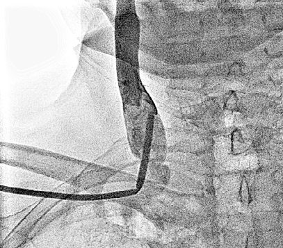 Complication during subclavian vein cannulation. Image courtesy of C. Michael Gibson and copylefted.