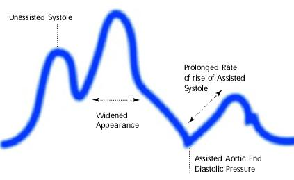 Assisted aortic end diastolic pressure may be equal to the unassisted aortic end diastolic pressure, rate of rise of assisted systole is prolonged and diastolic augmentation may appear of rise of widened