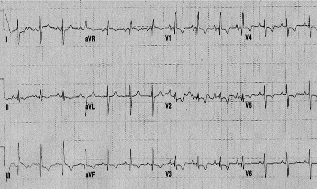 ECG of patient with pulmonary embolism showing S1 Q3 T3, Right bundle branch block pattern and flipped anterior T waves.
