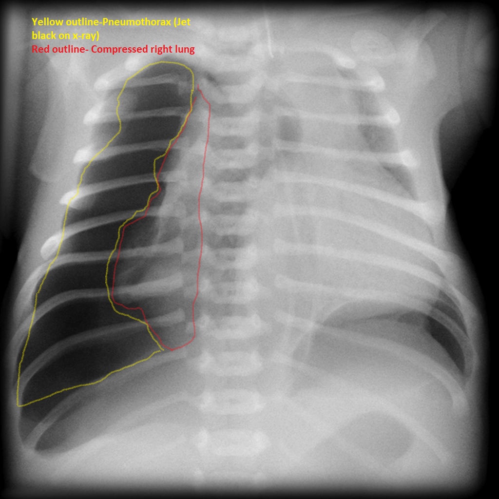 File:Tension-pneumothorax-1.jpg
