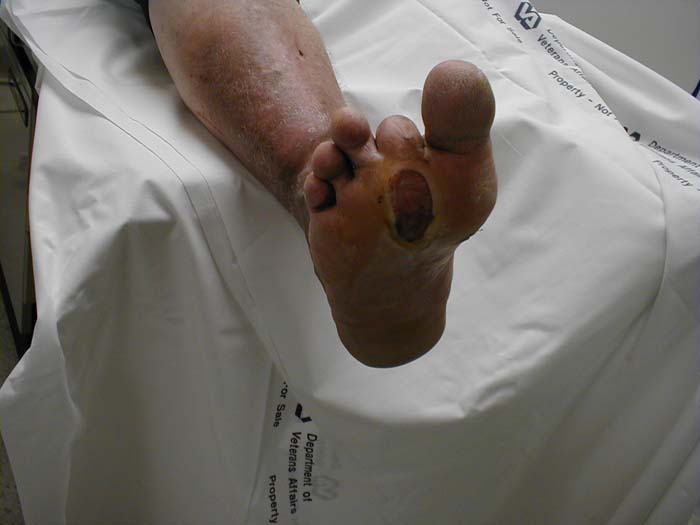 Diabetes induced neuropathy that has lead to painless ulcer on bottom of foot.
