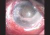 Corneal edema and severe anterior chamber exudation[15]