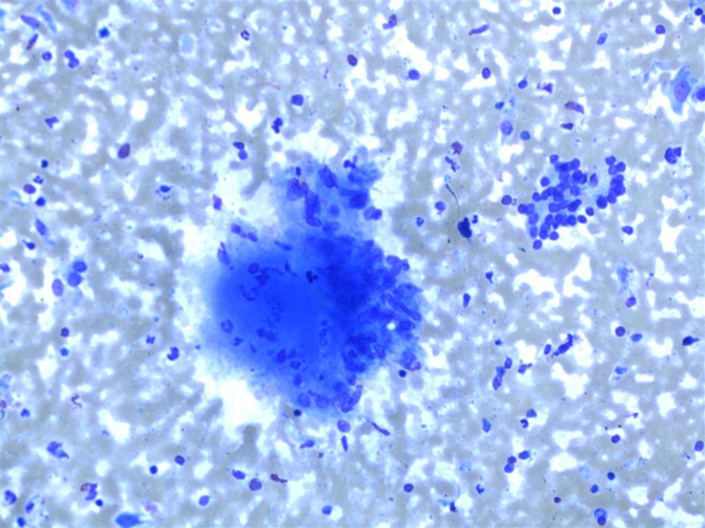 FNA smear of De Quervain's thyroiditis; ; Cluster of epithelioid histiocytes with associated inflammatory cells and debris and group of benign follicular epithelial cells. (Case courtesy of Dr Andrew Ryan, <a href="https://radiopaedia.org/">Radiopaedia.org</a>. From the case <a href="https://radiopaedia.org/cases/17052">rID: 17052</a>)
