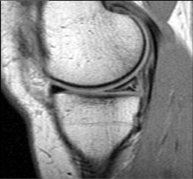 File:Tear-posterior-horn-medial-meniscus-002.jpg