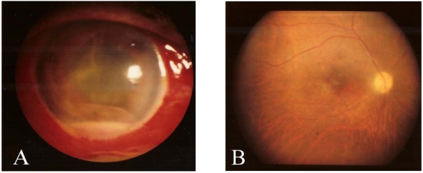 (A) Severe conjunctival injection, subconjunctival hemorrhage, corneal stromal edema, and hypopyon (B) Fundus photograph shows a mild pale color of optic disc & macular degeneration[27]