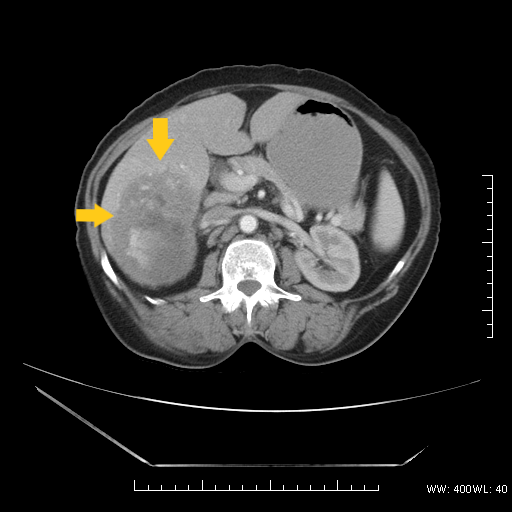 File:Hepatic Adenoma CT 2.png