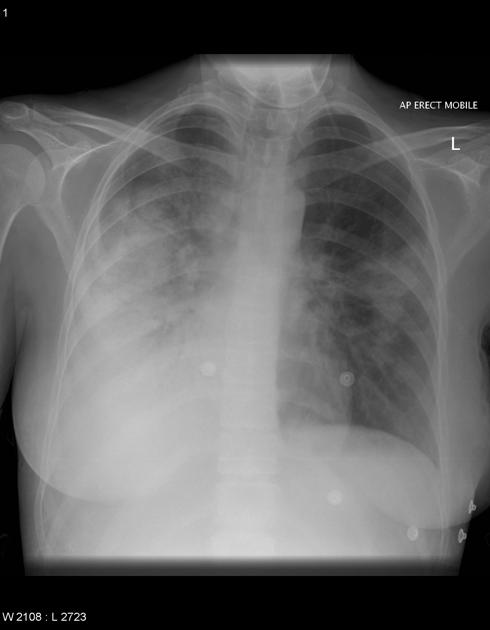 Extensive consolidation and air bronchograms with loss of the right hemidiaphragm in keeping with right lower lobe pneumonia. Image courtesy of Dr Frank Gaillard, Radiopedia. (original file here). Creative Commons BY-SA-NC