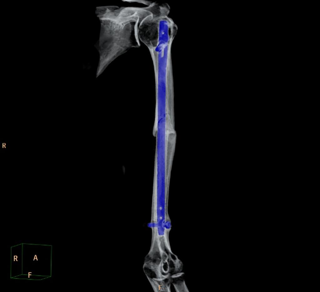 File:Humeral-shaft-fracture-non-union-with-osteosynthesis.jpg