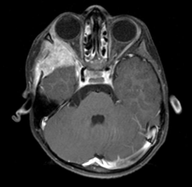Brain MRI reveals destructive lesion of the sphenoid wing on right side with thickening of the pituitary stalk and enhancing soft tissue in the sella and along the posterior aspect of the clivus[1]