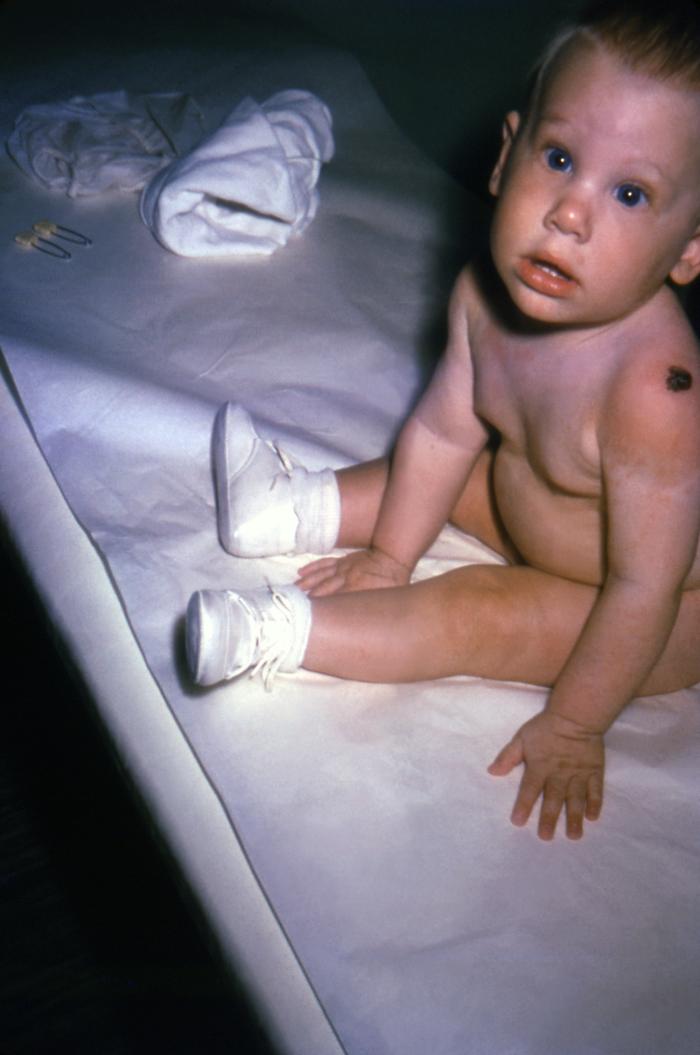 6 month-old male infant was a recipient of a smallpox vaccination in his left shoulder, and subsequently developed a generalized, full-body rash, due to an allergic reaction to the vaccination. Note the diffuse rash on this child’s extremities, and torso.Adapted from Public Health Image Library (PHIL), Centers for Disease Control and Prevention.[3]
