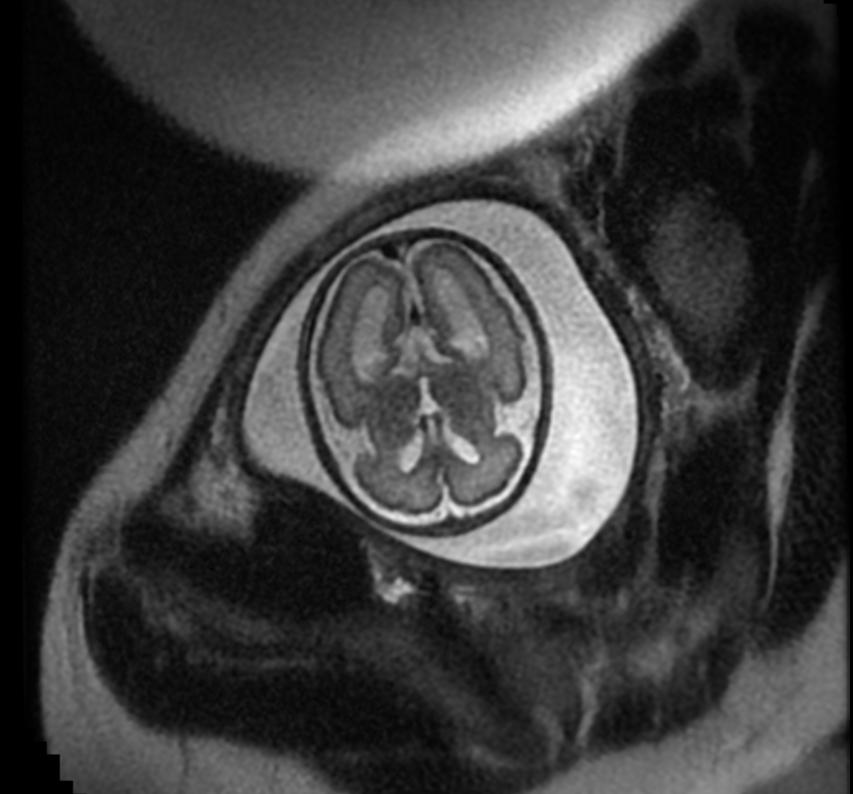 File:Aqueductal stenosis fetal MRI 003.jpg