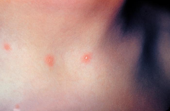Patient with cervical skin lesions caused by chickenpox. From Public Health Image Library (PHIL). [24]