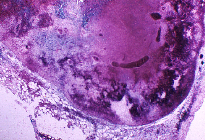 "Severe hemorrhagic necrosis of lymph node due to anthrax”Adapted from Public Health Image Library (PHIL), Centers for Disease Control and Prevention.[21]