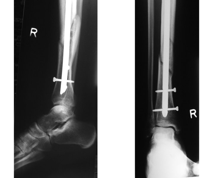 X-ray showing fractured tibia and pinning.