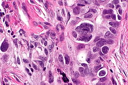 File:Serous carcinoma - omentum 3 -- very high mag.jpg