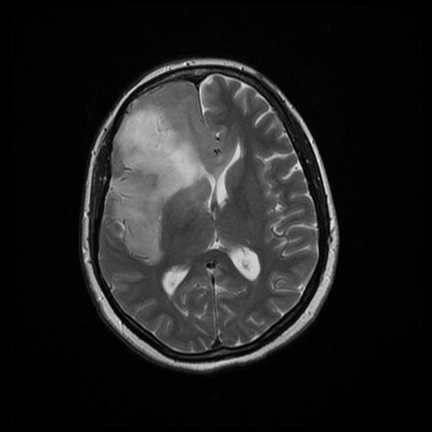 T2 MRI of gliomatosis cerebri.[3]